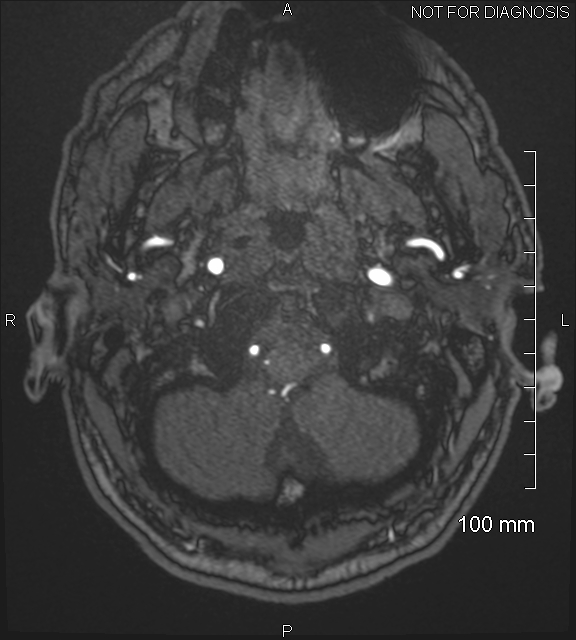 Anterior cerebral artery aneurysm (Radiopaedia 80683-94127 Axial MRA 10).jpg
