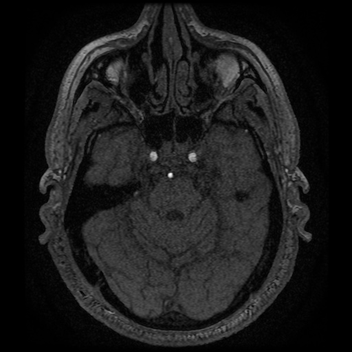 Anterior cerebral artery infarction (Radiopaedia 46794-51323 Axial MRA 44).jpg