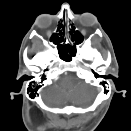 Anterior cerebral artery territory infarct (Radiopaedia 39327-41581 B 46).png