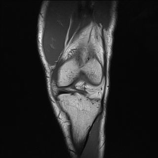 File:Anterior cruciate ligament full thickness tear (Radiopaedia 66268-75467 Coronal T1 6).jpg