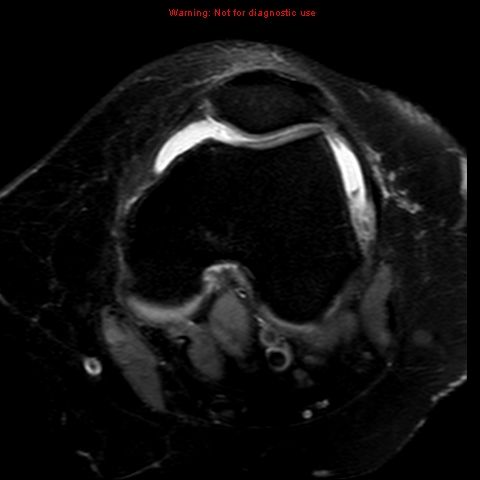 File:Anterior cruciate ligament tear (Radiopaedia 12329-12612 Axial T2 fat sat 15).jpg