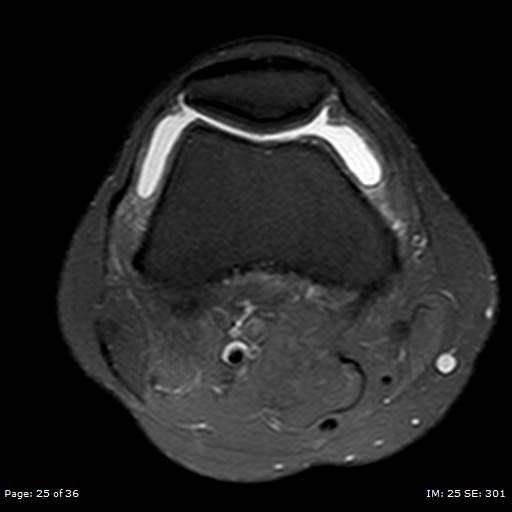 File:Anterior cruciate ligament tear (Radiopaedia 70783-80964 Axial PD fat sat 25).jpg