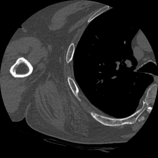 File:Anterior glenohumeral dislocation with Hill-Sachs lesion (Radiopaedia 62877-71249 Axial bone window 79).jpg