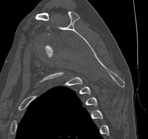 Anterior glenohumeral dislocation with Hill-Sachs lesion (Radiopaedia 62877-71249 Sagittal bone window 42).jpg