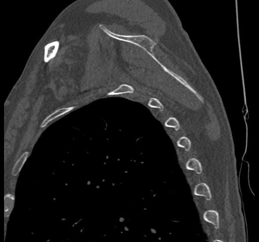 Anterior glenohumeral dislocation with Hill-Sachs lesion (Radiopaedia 62877-71249 Sagittal bone window 54).jpg