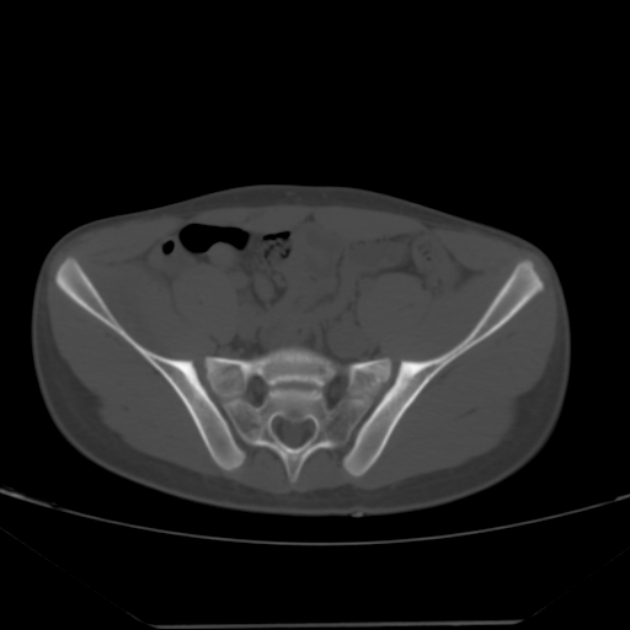 Anterior inferior iliac spine avulsion fracture (Radiopaedia 49469-54627 Axial bone window 13).jpg