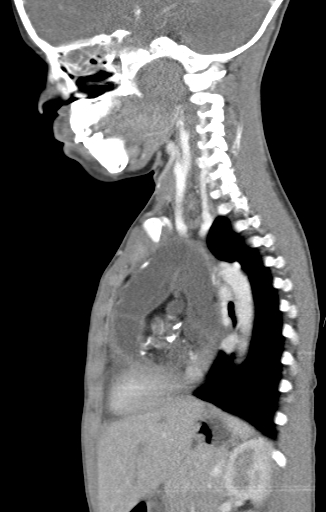 File:Anterior mediastinal teratoma (Radiopaedia 8593-9427 Sagittal 1).png
