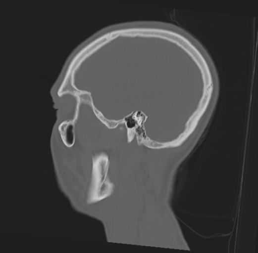 Anterior nasal spine fracture (Radiopaedia 46138-50494 Sagittal bone window 15).png