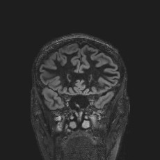 Anterior temporal encephalocele (Radiopaedia 82624-96808 Coronal FLAIR 14).jpg