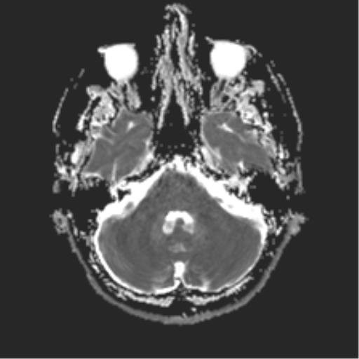 File:Anterior temporal lobe perivascular space (Radiopaedia 40946-43650 Axial ADC 6).png