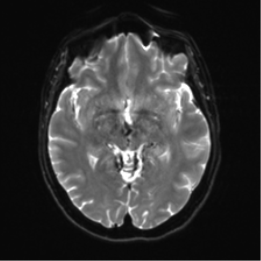 Anterior temporal lobe perivascular space (Radiopaedia 40946-43650 Axial DWI 12).png