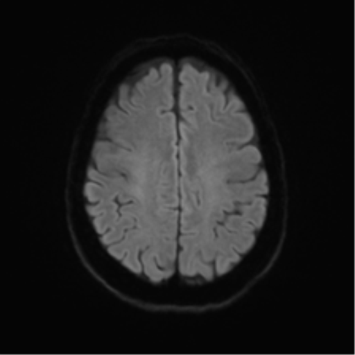 Anterior temporal pole cysts (Radiopaedia 46629-51102 Axial DWI 47).png