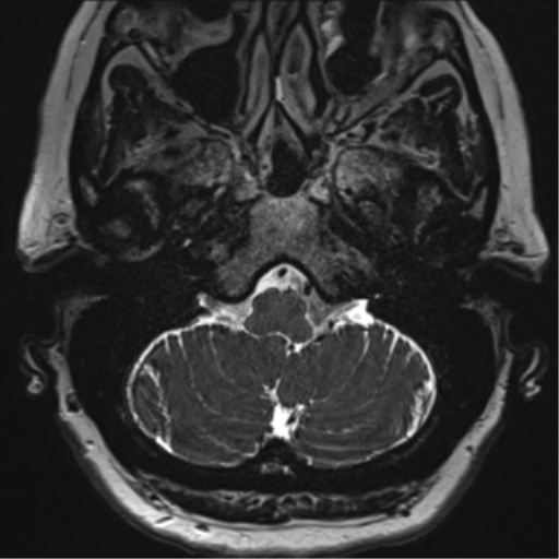 Anterior temporal pole cysts (Radiopaedia 46629-51102 Axial T2 16).png