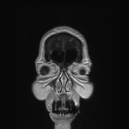Anterior temporal pole cysts (Radiopaedia 46629-51102 Coronal T1 C+ 168).png