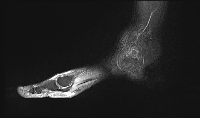 File:Anterior tibial artery false aneurysm (Radiopaedia 88984-105808 Sagittal STIR 24).jpg
