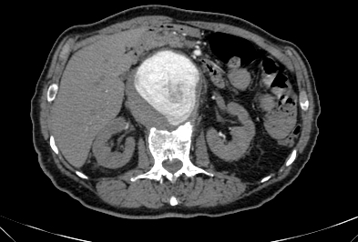 Anterior vertebral scalloping (abdominal aortic aneurysm) (Radiopaedia 66744-76067 F 24).jpg