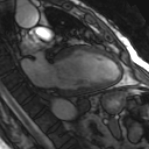 File:Anteroseptal hypokinesia after myocardial infarction (Radiopaedia 15978-15633 2 chamber view SSFE 1).jpg