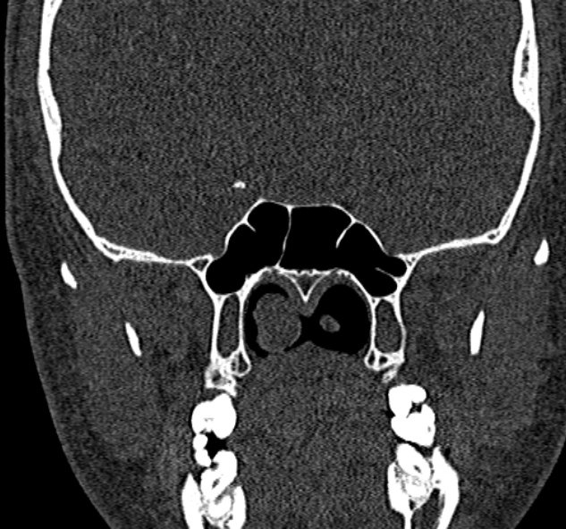 Antrochoanal polyp (Radiopaedia 30002-30554 Coronal bone window 61).jpg
