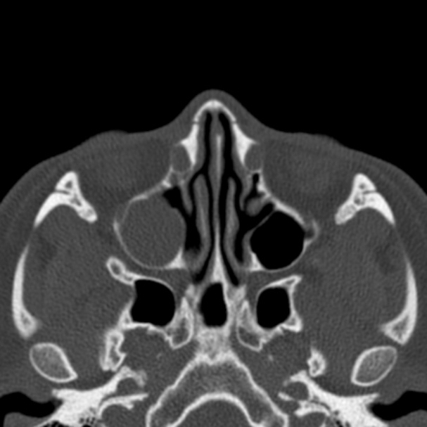 Antrochoanal polyp (Radiopaedia 33984-35202 Axial bone window 37).jpg