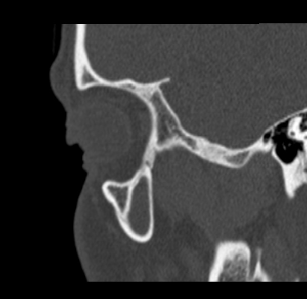 Antrochoanal polyp (Radiopaedia 33984-35202 Sagittal bone window 6).jpg