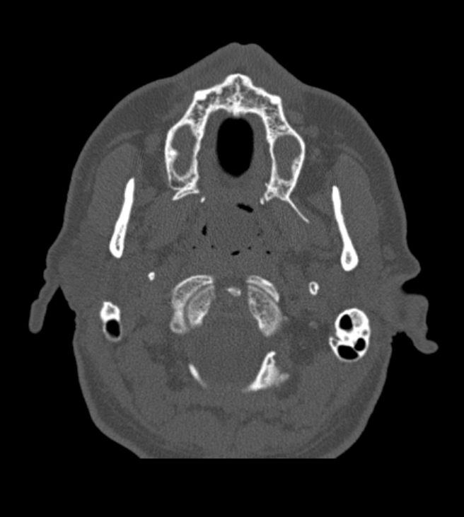 Antrochoanal polyp (Radiopaedia 79011-92169 Axial bone window 6).jpg