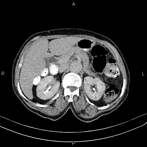 Aortic aneurysm and Lemmel syndrome (Radiopaedia 86499-102554 Axial C+ delayed 26).jpg