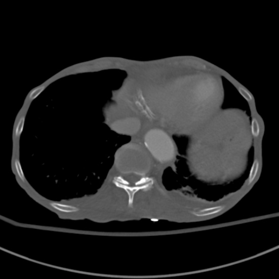 Aortic aneurysm with spinal destruction (Radiopaedia 42301-45410 Axial bone window 8).jpg