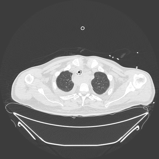 Aortic arch aneurysm (Radiopaedia 84109-99365 Axial lung window 60).jpg