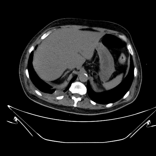Aortic arch aneurysm (Radiopaedia 84109-99365 Axial non-contrast 263).jpg