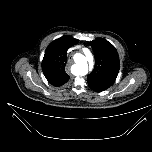 Aortic arch aneurysm (Radiopaedia 84109-99365 B 192).jpg