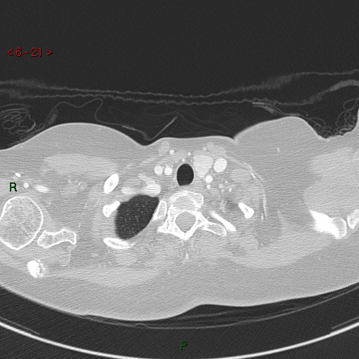 Aortic arch origin of left vertebral artery (Radiopaedia 51520-57286 Axial lung window 21).jpg