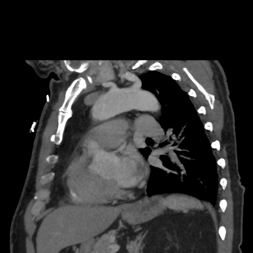 File:Aortic dissection- Stanford A (Radiopaedia 37759-39664 D 21).png