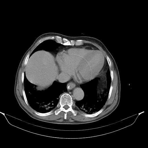 File:Aortic dissection- Stanford type A (Radiopaedia 22085-22085 Axial C+ delayed 4).jpg