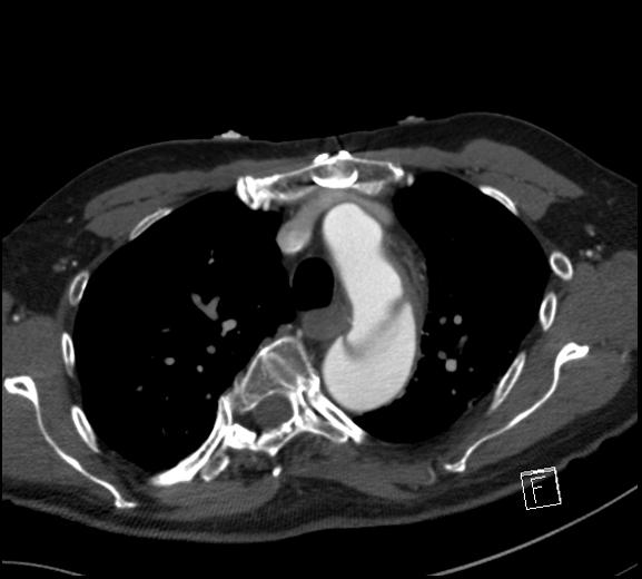 File:Aortic dissection (CTPA) (Radiopaedia 75506-86750 A 27).jpg