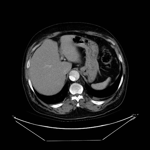 Aortic dissection (Radiopaedia 62562-71000 A 44).jpg
