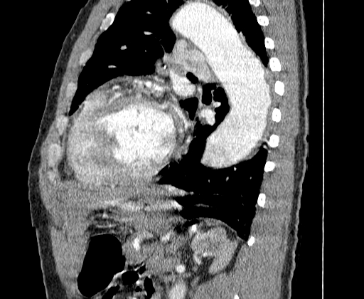 Aortic dissection - Stanford A -DeBakey I (Radiopaedia 28339-28587 C 60).jpg