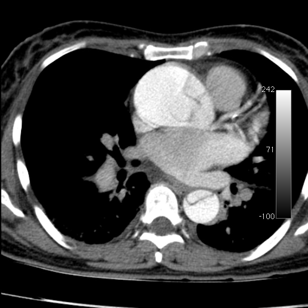 Aortic dissection - Stanford type A (Radiopaedia 29247-29659 A 43).jpg