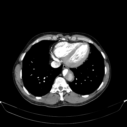 Aortic dissection - Stanford type A (Radiopaedia 83418-98500 A 49).jpg