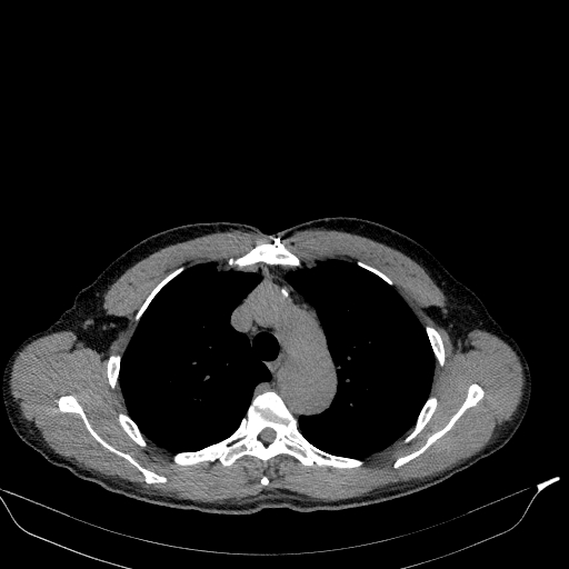 File:Aortic dissection - Stanford type A (Radiopaedia 83418-98500 Axial non-contrast 11).jpg