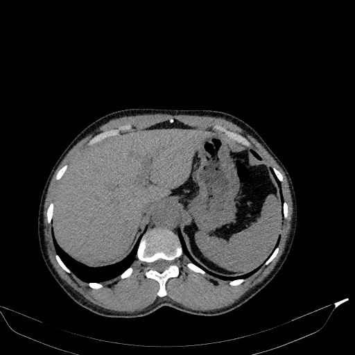 Aortic dissection - Stanford type A (Radiopaedia 83418-98500 Axial non-contrast 42).jpg