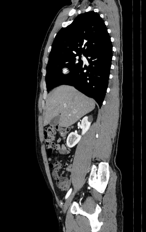 Aortic dissection - Stanford type A (Radiopaedia 83418-98500 B 1).jpg