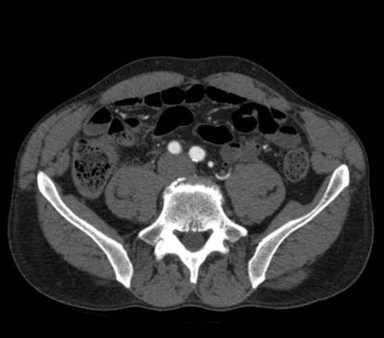 File:Aortic dissection - Stanford type B (Radiopaedia 73648-84437 A 202).jpg