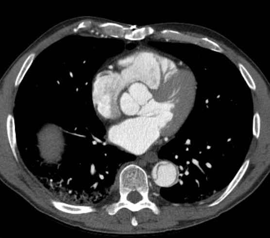 Aortic dissection - Stanford type B (Radiopaedia 73648-84437 A 70).jpg