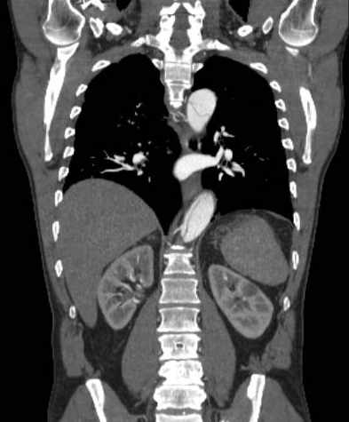 File:Aortic dissection - Stanford type B (Radiopaedia 73648-84437 B 79).jpg