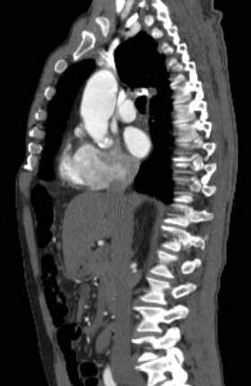 Aortic dissection - Stanford type B (Radiopaedia 73648-84437 C 87).jpg