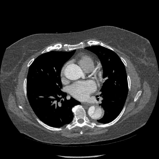 Aortic dissection - Stanford type B (Radiopaedia 88281-104910 A 46).jpg
