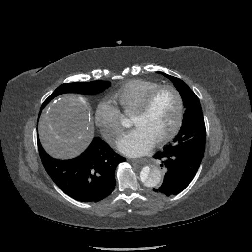 Aortic dissection - Stanford type B (Radiopaedia 88281-104910 A 59).jpg