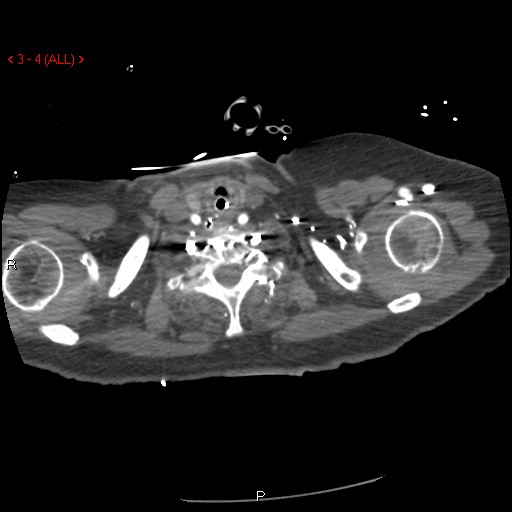 Aortic intramural hematoma (Radiopaedia 27746-28001 A 4).jpg