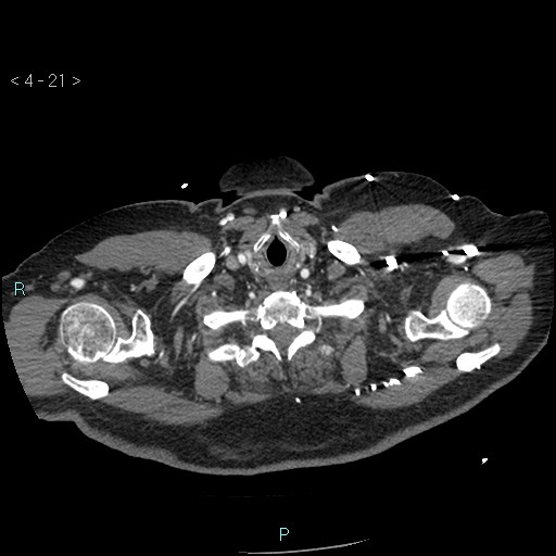 File:Aortic intramural hematoma (Radiopaedia 48463-53380 B 11).jpg