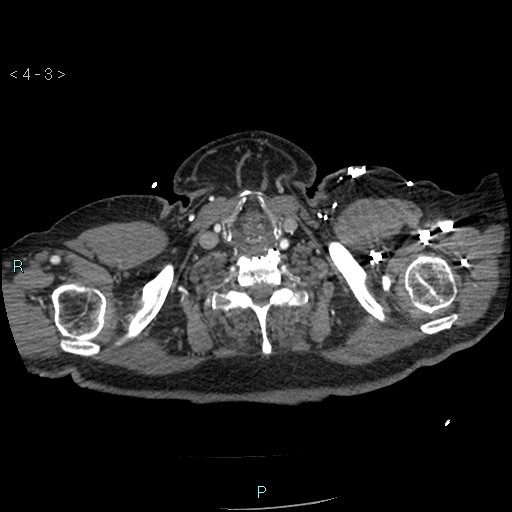 File:Aortic intramural hematoma (Radiopaedia 48463-53380 B 3).jpg